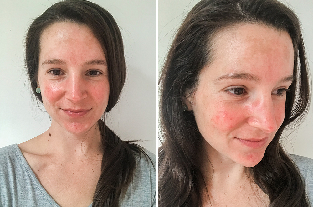 What It s Like Living With Rosacea ORACEA Capsules Review
